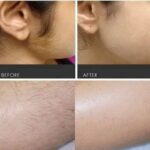 Episoft Hair Removal Serum 35ml – অবাঞ্ছিত লোম দূর করার কার্যকর সমাধান